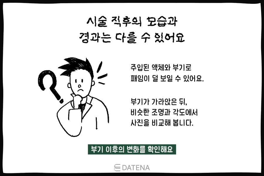 说明治疗刚结束时因肿胀和液体注入，凹陷可能显得不那么明显的人物插图