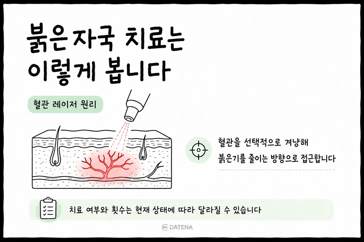 针对红色痘印扩张血管的血管激光原理示意图
