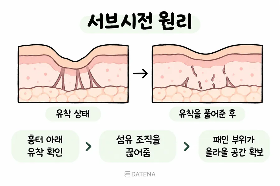 皮下分离术分离凹陷疤痕下方粘连组织的原理示意图